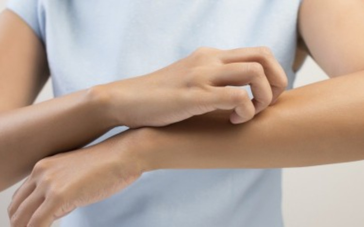 Urticaria: una enfermedad de la piel que puede persistir por años