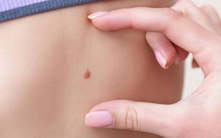 La Sociedad Argentina de Dermatología alienta el cuidado de la piel durante todo el año y recuerda la importancia de realizarse un examen periódico de manchas y lunares para prevenir el cáncer de piel.